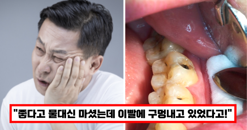 이빨-치아-구멍-탄산수